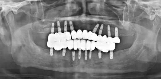 Panoramic X-ray showing full-mouth dental implants — educational image from Del Amo Dental Group, Torrance CA