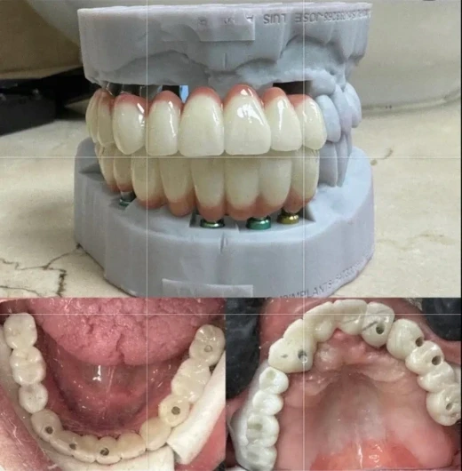 Dental implant model showing implant-supported prosthesis design for full-mouth rehabilitation