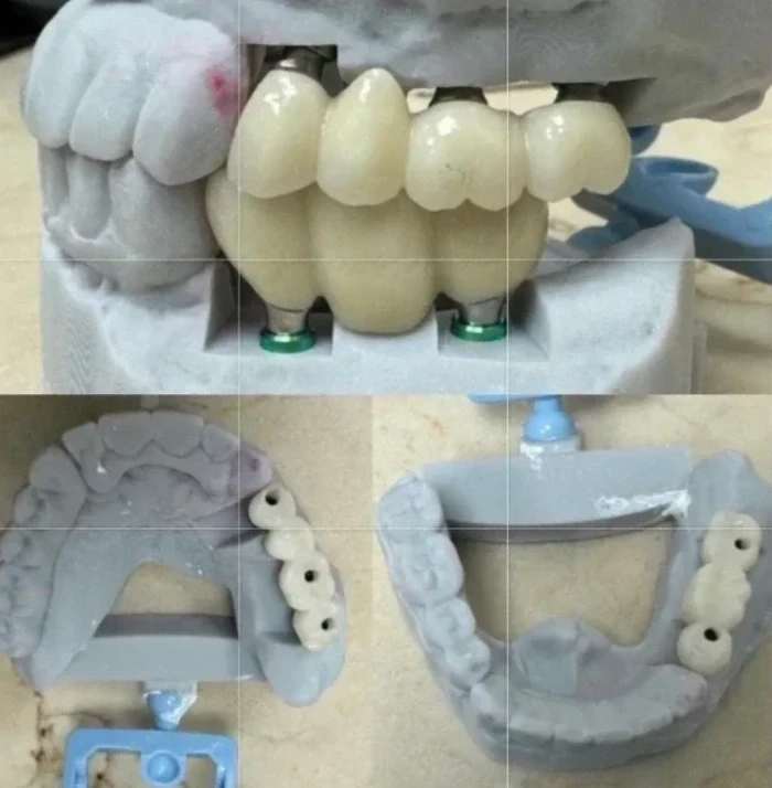 Detailed view of implant-supported dental prosthesis model during full-mouth reconstruction planning