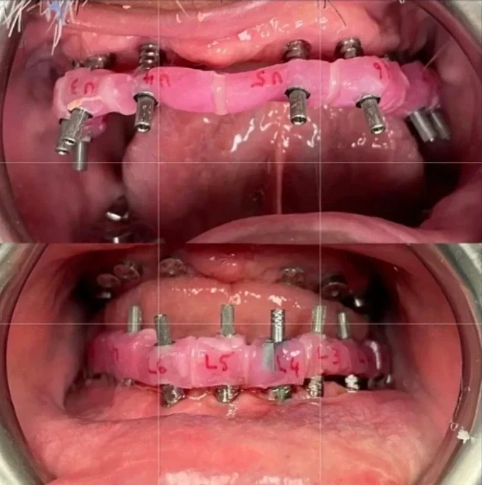 Clinical view of dental implant placement during full-mouth rehabilitation procedure at Del Amo Dental Group