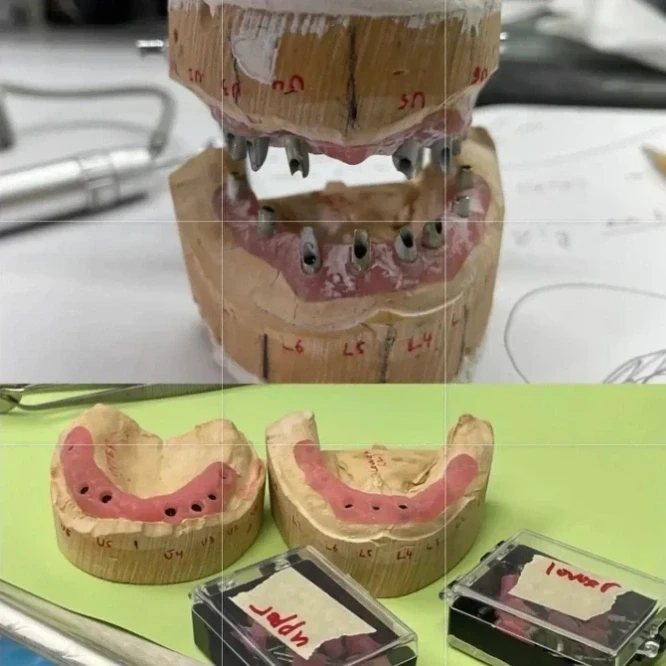 Dental laboratory models showing upper and lower arch implant prosthesis components during full-mouth reconstruction