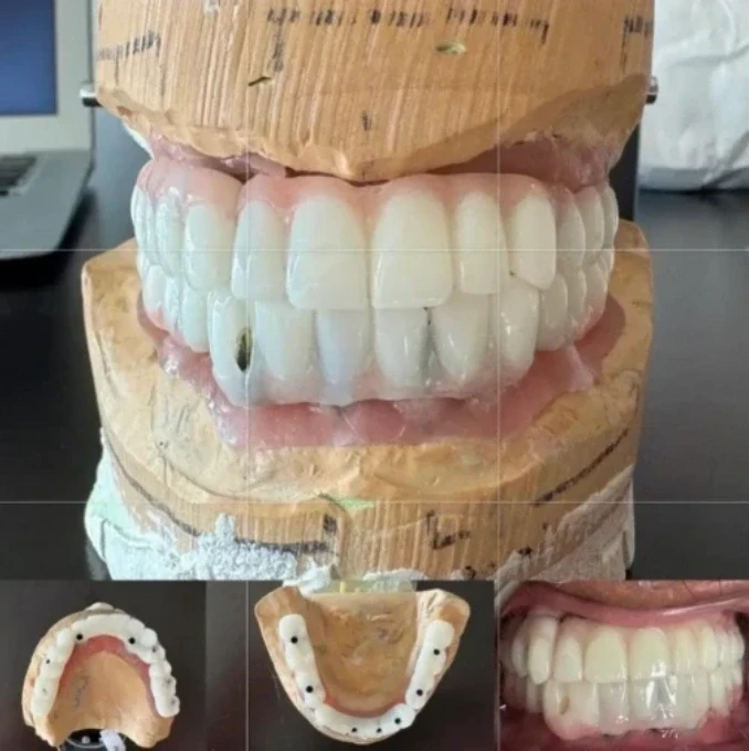 Final implant-supported full-arch prosthesis — completed full-mouth dental implant rehabilitation result