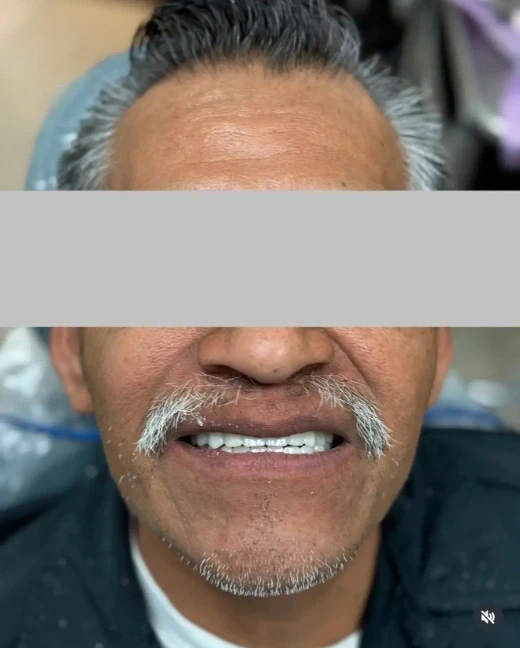 Detail view of the completed implant-supported full-arch prosthesis — natural-looking ceramic teeth on implant framework, Del Amo Dental Group, Torrance CA